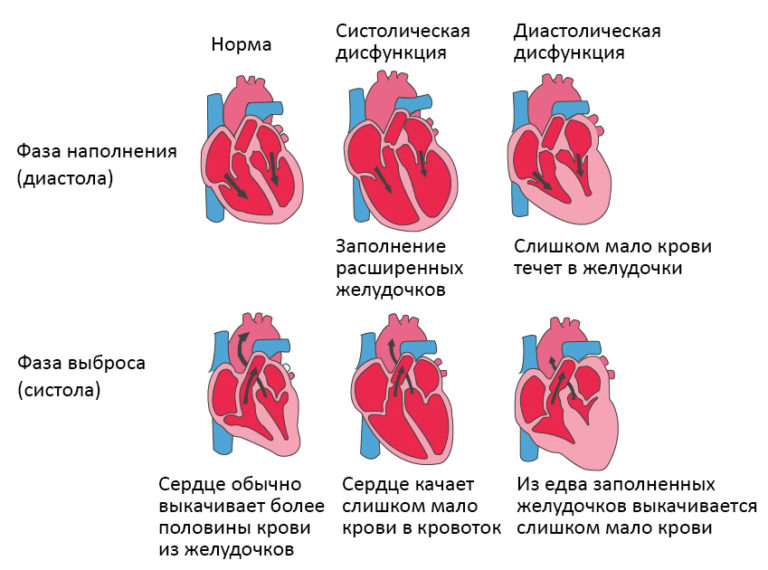 Что такое острая сердечная недостаточность